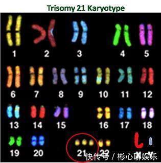 智力|每20分钟就有1位唐氏儿出生，孕妇该如何避免生出智力低的唐宝