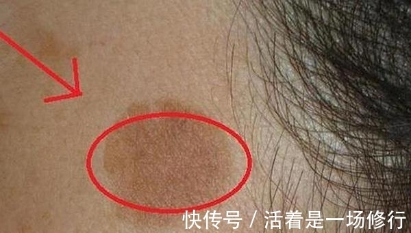 维生素e|女人多大年纪,会开始长老年斑?老了不想脸上有斑要怎么做?