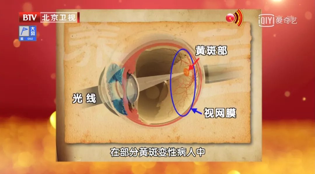 病变|这种眼疾来势汹汹,却被太多人忽视!眼疲劳、视力下降、有小黑点…可能是“致盲”信号!