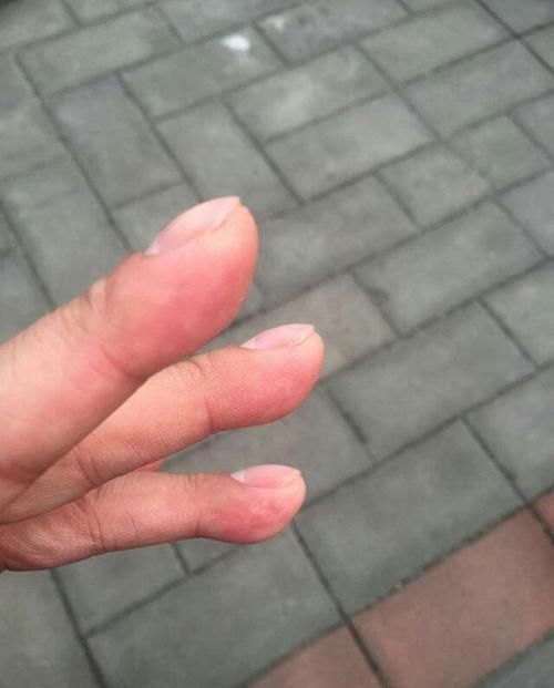 上腔静脉|肺癌,或许有手指、颜面部的表现,但有这些症状不一定就是肺癌!