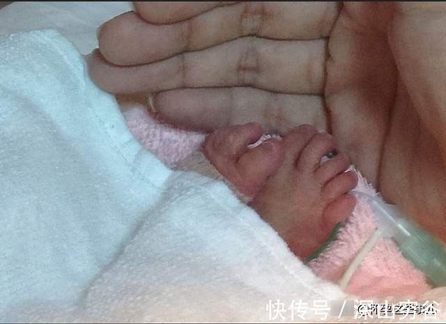软便剂|终于卸货啦！让我不敢再回想的双胞胎待产和生产记录，住进ICU