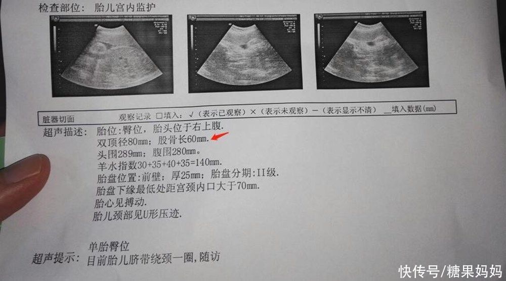 孕周|产检时胎儿“股骨短”，意味着孩子是矮个子吗？背后原因很复杂