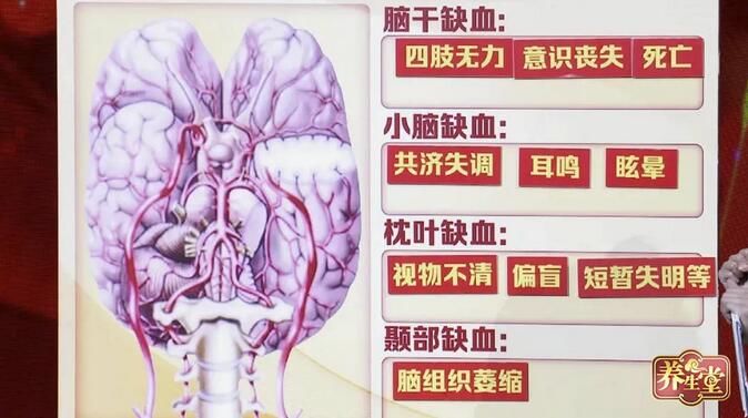 枕叶|特殊脑中风危机，锁骨下动脉狭窄