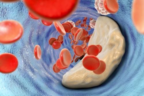 心脑血管疾病|71岁老人顿顿吃肉，血管依旧通畅，医生：坚持3件事，你也可以