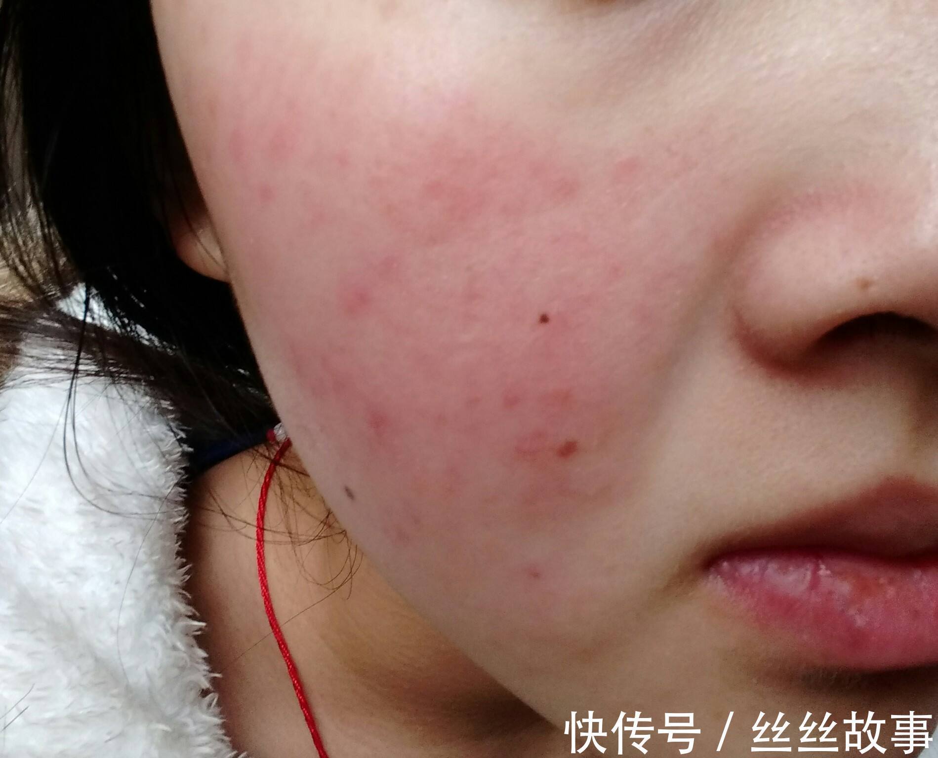 毛细血管|脸红不都是因为情绪，可能是毛细血管扩张的问题，来看看怎么办