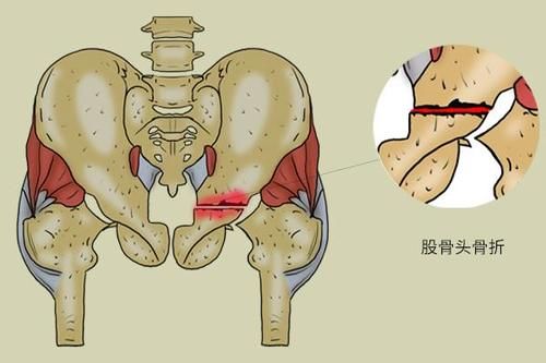 伤筋动骨一百天，骨科医生提醒您，人老之后，4种营养及时补