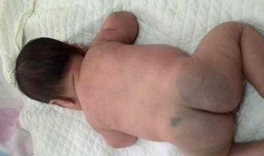 淤青|婴儿出生时,屁股上为啥都有淤青?若是有这几种记号,宝妈别忽视