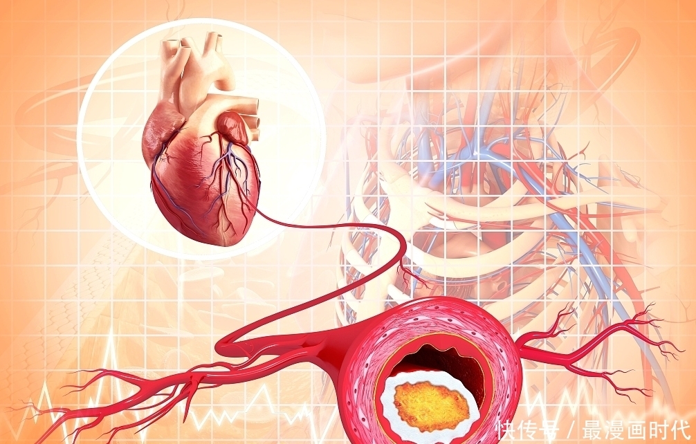 心脑血管疾|心梗“偏爱”6大人群!提醒:注意5个表现,别让心梗“钻空子”