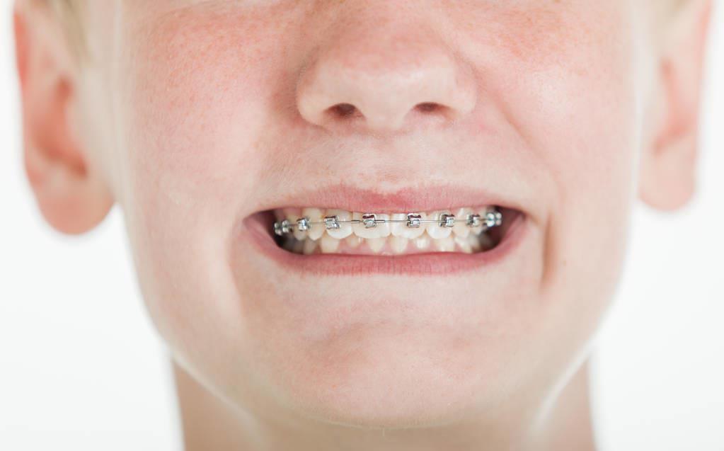 牙齿矫正|儿童做牙齿矫正三个最佳时间:家长要牢记,矫治越早干预效果越好
