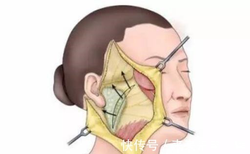 无痕 “大拉皮手术”后又美又无痕,医生是要费些心思的!