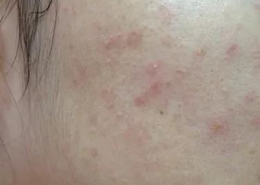 毛孔|闭口痘痘能做哪些皮肤管理？