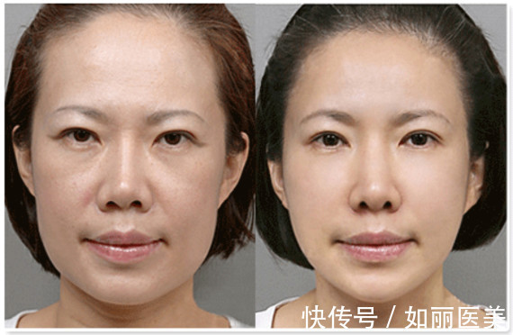 超声提升 热玛吉&超声提升,谁是抗衰NO.1?抗衰选它就对了!