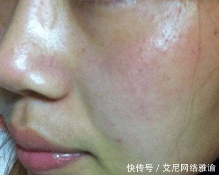 皮肤科医生提醒:这几款火爆全网的护肤品,含有刺激性激素