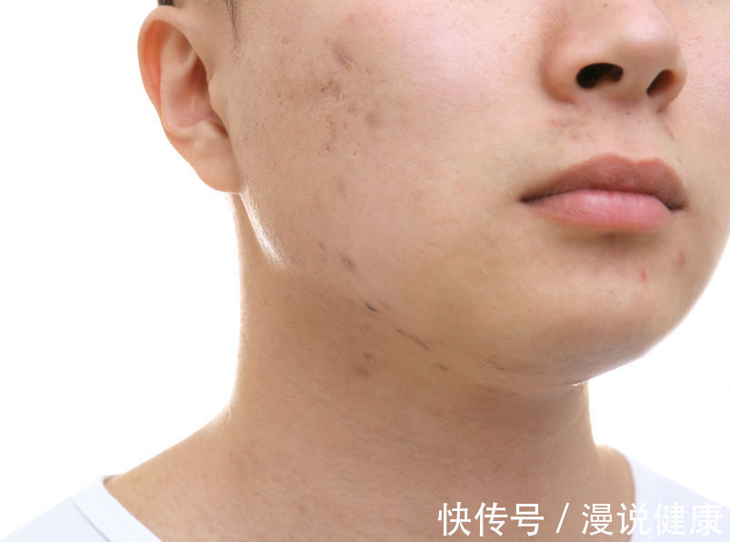 清洁|青春痘也即将有疫苗了?毁你颜值的这些痤疮,又该拿它怎么办?