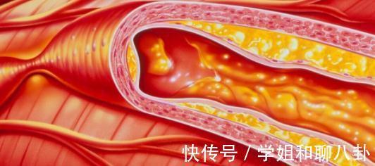 总胆固醇|老年人有这3种症状,心肌缺血可能就潜伏在身后,早知早预防