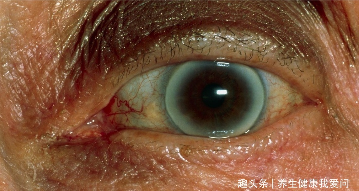 血脂异常|医生提醒:眼睛出现2种异常,可能是血脂高了,尽早去医院排查