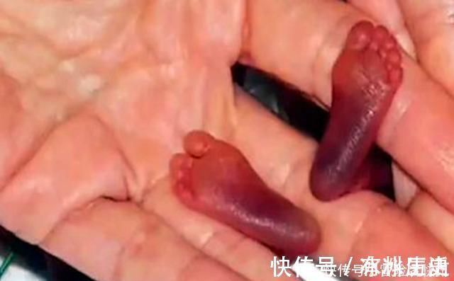 颜值|14年过去,原本身体巴掌大“世界最小宝宝”,如今颜值高到认不出