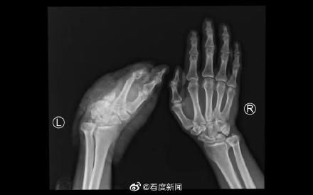 男子|男子断掌超24小时再植成功 手术超6小时