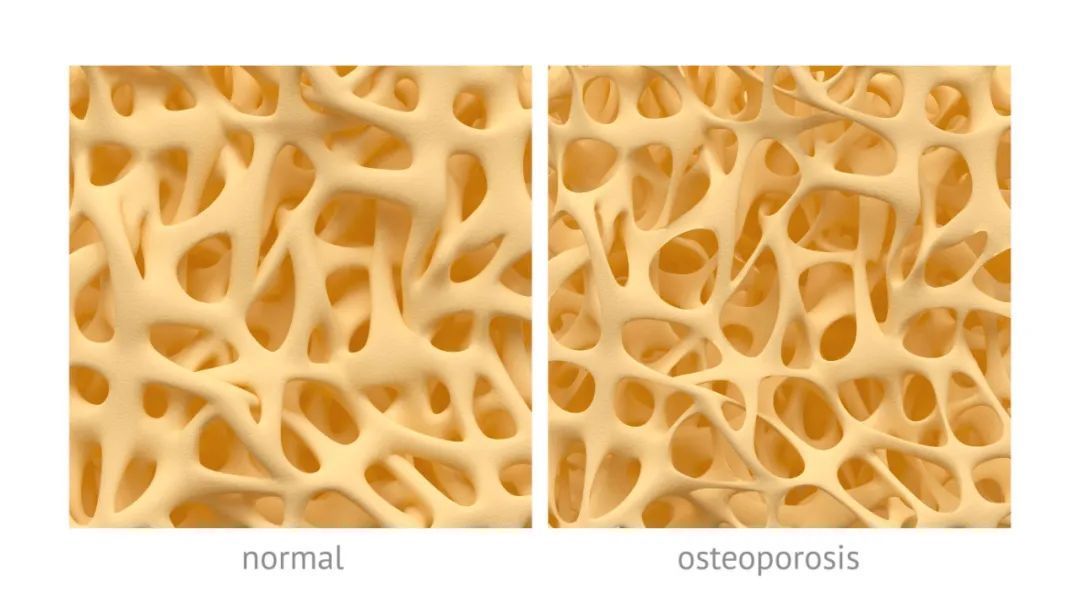 钙质|核桃是骨质疏松的“发物”？想要避免骨质疏松，哪些食物需忌口？