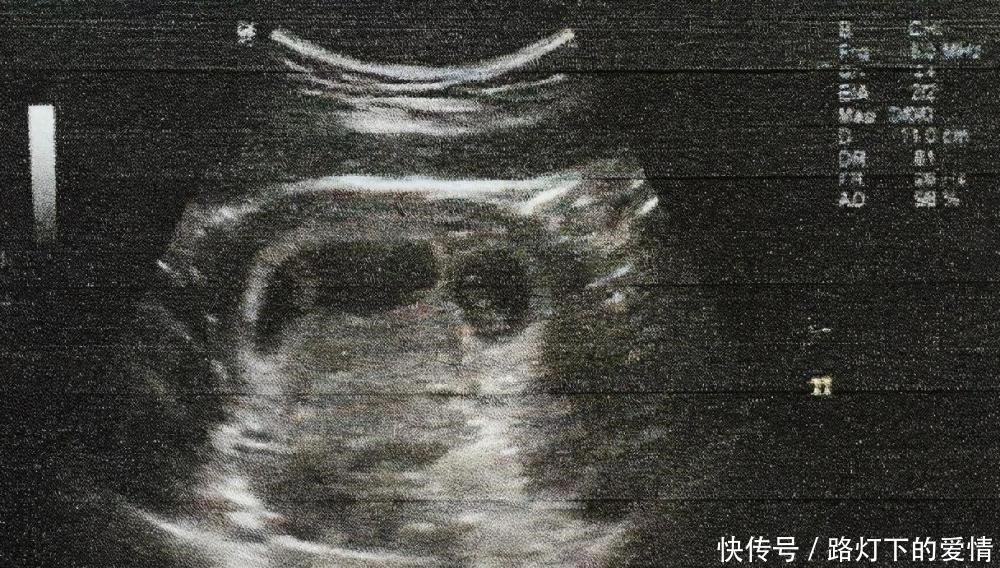 身体|怀孕后，身体出现这5种反应，可能是“胎停育”，孕妇要立即就医