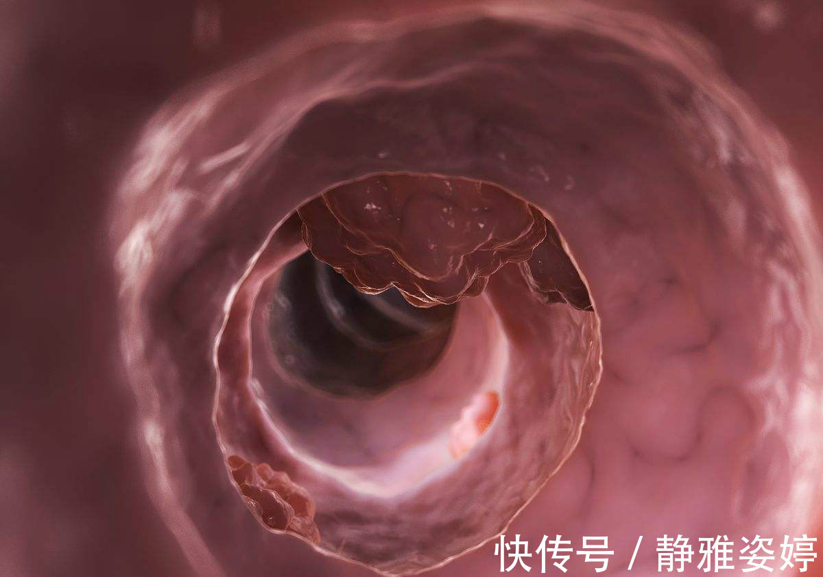 大肠癌|大肠癌一发现就是晚期，肿瘤科医生忠告，四个症状别再一拖再拖