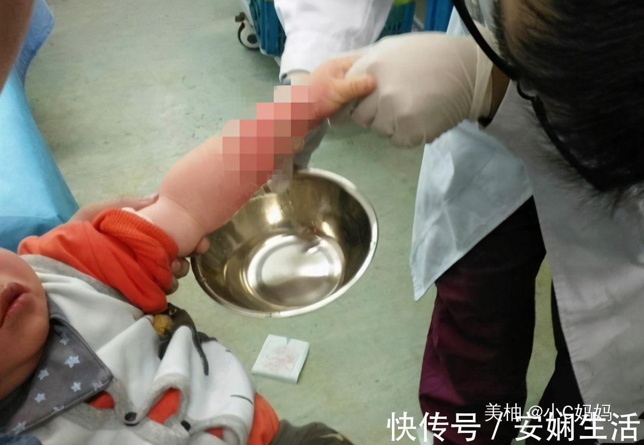 宝妈|3岁男孩被开水烫伤,宝妈的急救方法,医生称赞连连