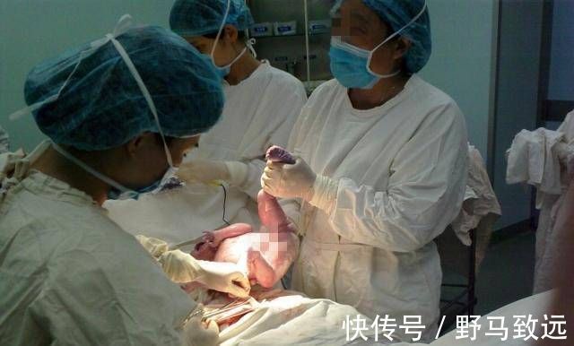 顺产|顺产和剖腹产哪个疼生过的妈妈来告诉你快生了的妈妈快来看