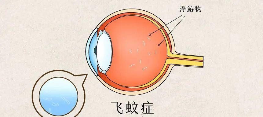 飞蚊症可以做近视手术吗 医生 不影响 但症状依然在 全网搜