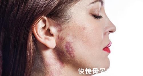 色斑|身体发现了5个异常变化时,也许是肝硬化的“前兆”,一定要留意