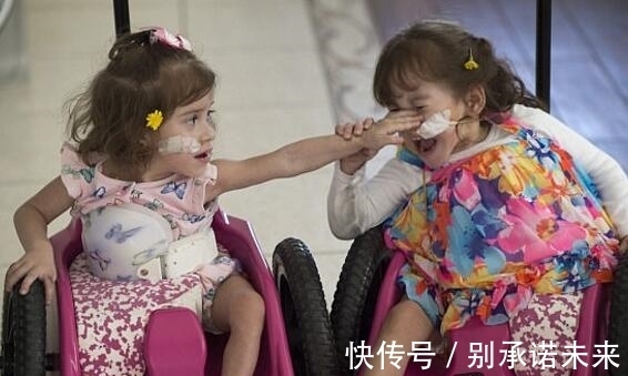 姐妹花 这对连体姐妹花,手术成功分离,每人拥有一条腿,未来的路很艰难