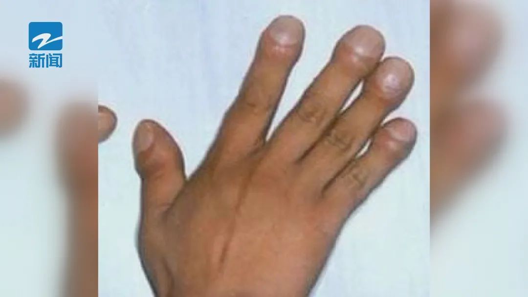 浙大一院|小伙一年长高35厘米!医生提醒:这些日常变化要注意