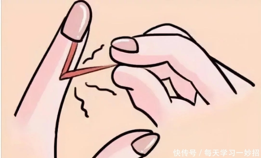 医院|手上长倒刺千万不要随便拔，它可能会让你进医院，不要小瞧了