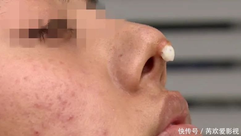 漂亮姑娘刚怀孕,鼻尖出现神秘白色物体!婆婆追问下,她瞒不住了…