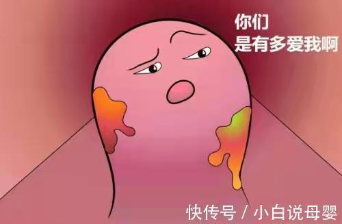 便秘|自己治疗痔疮的方法?学会这5个小妙招,彻底解放你的小菊花