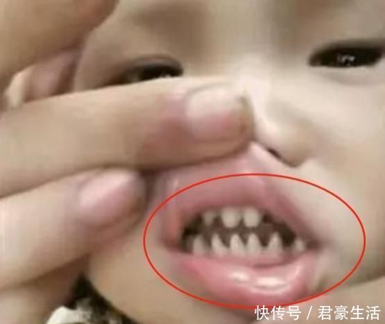 宝宝|宝宝长了一口“鲨鱼牙”，妈妈无奈送医求助，医生：怪家长无知