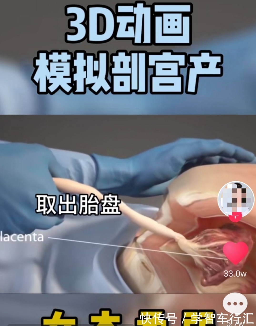 谢楠|剖宫产有多“伤”妈妈,几张3D过程图带你了解,感恩老婆和妈妈