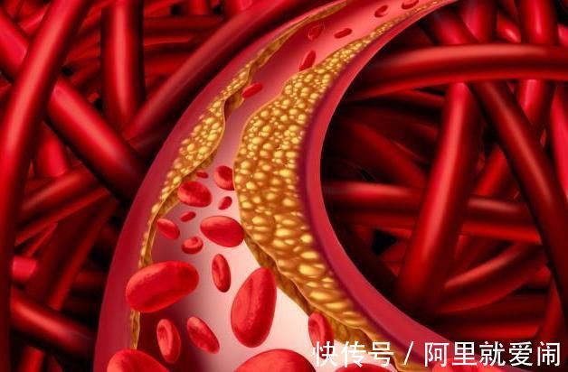 高脂血症|比“大鱼大肉”还可怕的升脂加速器，你若天天吃，血脂将越来越高