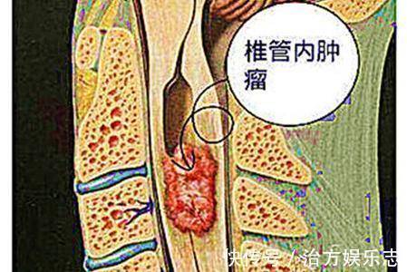 手麻|37岁女子手麻,以为是颈椎病,医院检查颈椎里有个鸡蛋大的肿瘤