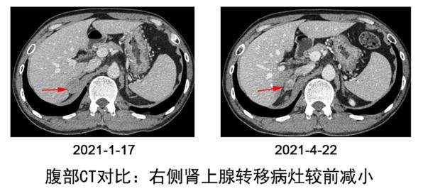 免疫治疗|免疫+放疗+细胞因子 “三联疗法”助力难治性甲状腺癌患者康复