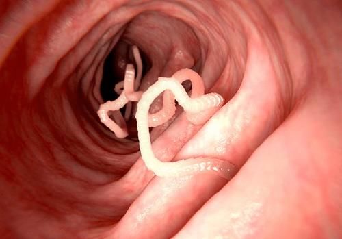 结肠癌|大肠癌的罪魁祸首已经找到，晨起坚持三个习惯，肠道才会更健康