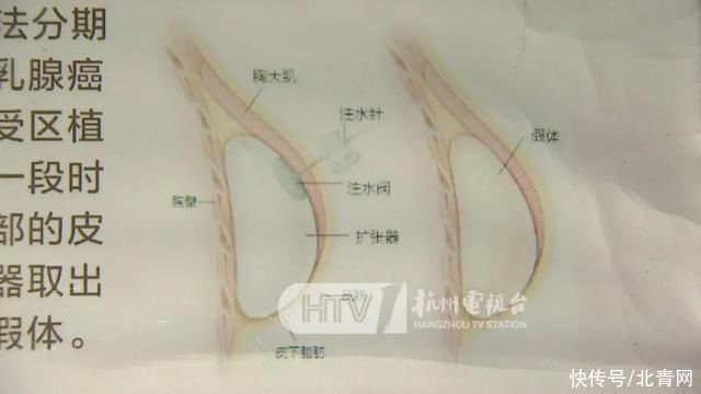 疾病|发现胸部肿块，大伯一查竟然是乳腺癌！最近已有多例，有这个疾病要做检查……