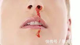 疾病|这5个“暗号”是脑血栓前兆，医生提醒早上尤其要注意“防栓”