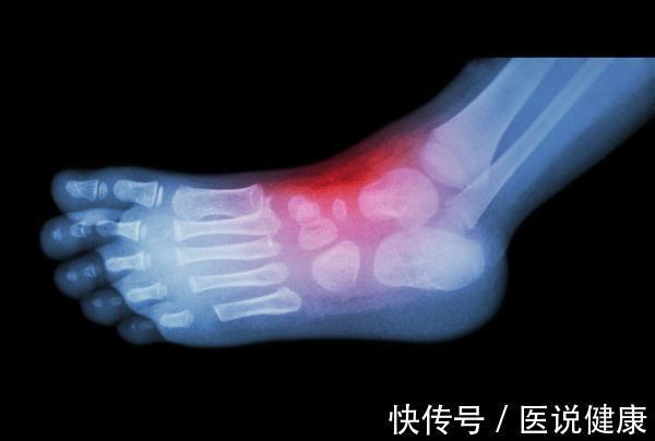 患者|明明都是高尿酸血症,为什么自己却出现痛风,看完你就了解了