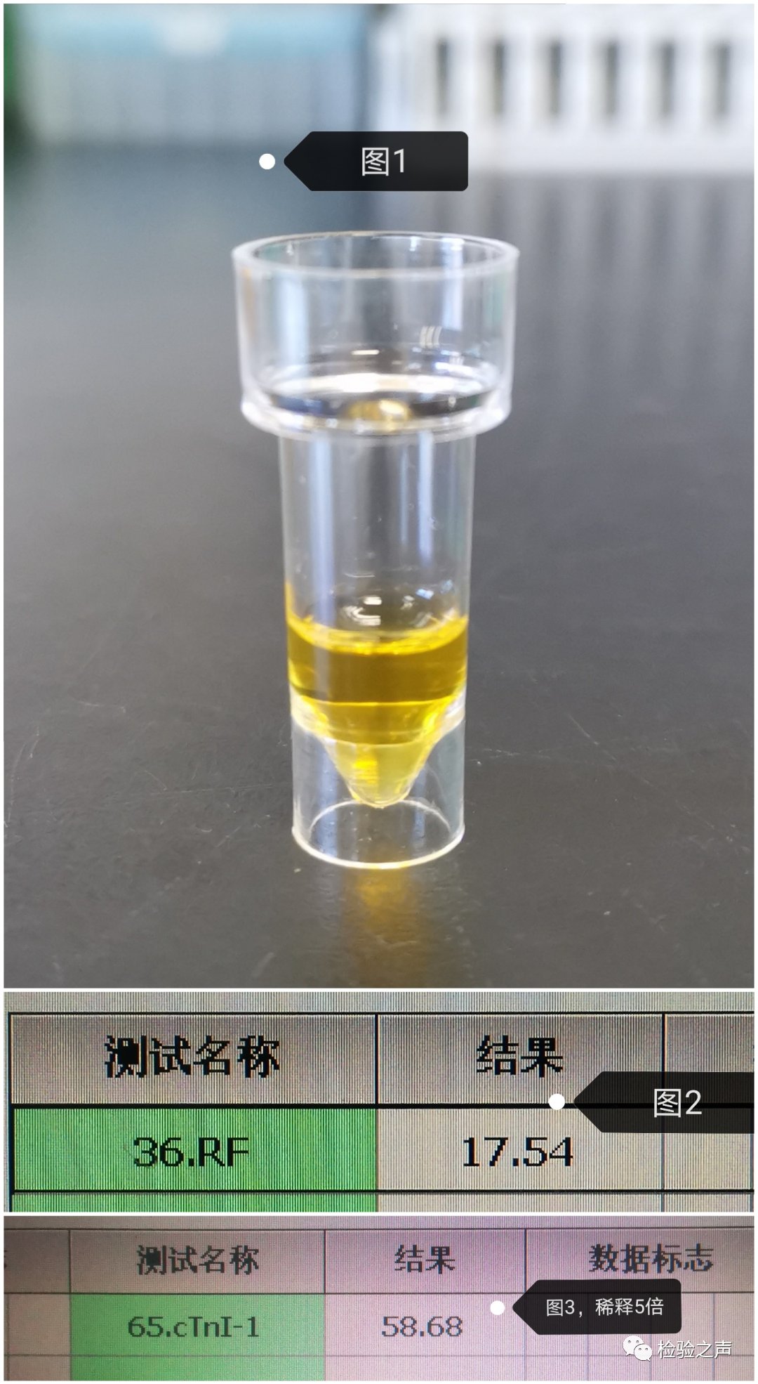 蛛网膜下腔出血|肌钙蛋白I(cTnI)如此之高，竟是因为脑血管意外？