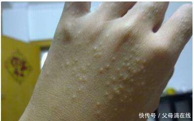 一到夏天手上长满水疱 非常痒 一抓就破 怎么办 快资讯 一到夏天手上长满水疱 非常痒 一抓就破 怎么办 快资讯