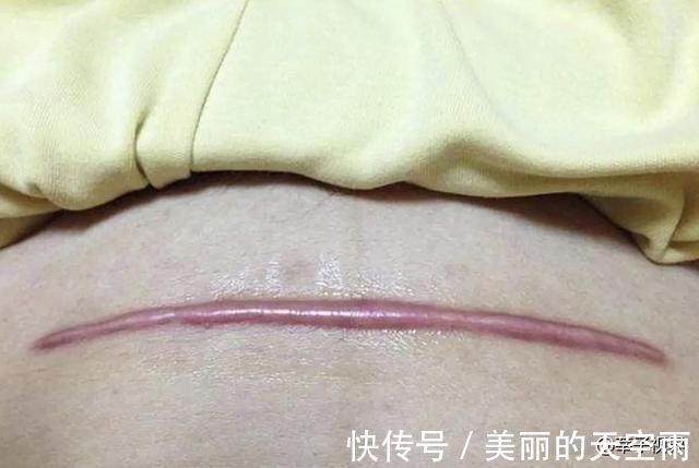 麻药|“假如可以重来,我会选择顺产”,95后剖产妈妈的哭诉,值得警醒