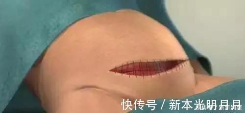 自然分娩|剖腹产到底是怎么“剖”的一组图看清全过程,每个妈妈都是超人