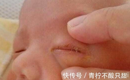 新生儿|宝宝出生三天无法睁开眼睛,医生检查后,怒斥家人无知!