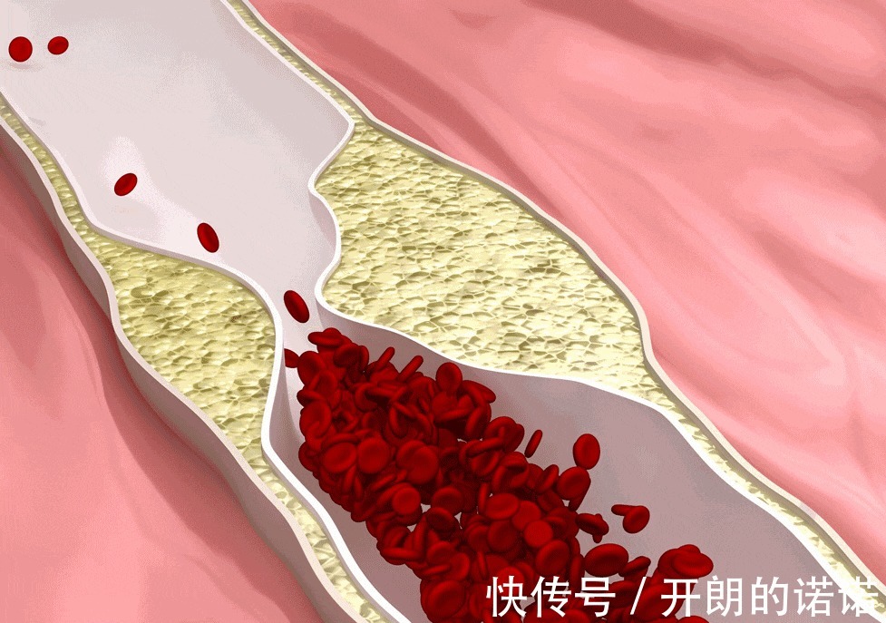 服用|做血脂检查应该注意哪几点检查单的4个指标,或不容忽视