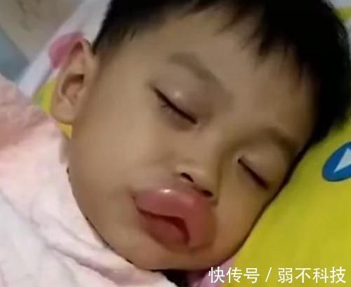 香肠嘴|熊孩子偷吃了一颗葡萄,嘴巴变成了香肠嘴,医生看了都憋笑